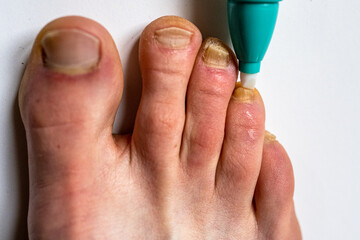 Using a pen against nail fungus. Nail fungal infection treatment.