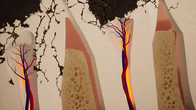 Molar teeth damaged by caries. Medically accurate tooth 3D animation
