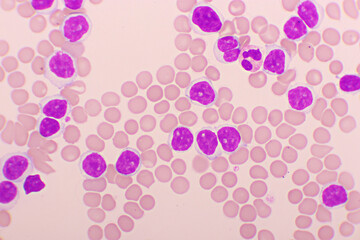 Acute lymphocytic leukemia or ALL cells in blood smear, analyze by microscope, 1000x