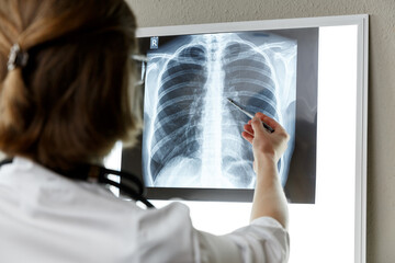 Pulmonologist therapist examining an x-ray of lungs.