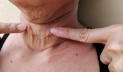 Portrait showing the fingers touching the flabbiness adipose hanging under the neck, problem wrinkles and cellulite under the chin, flabby skin of the woman, concept health care.