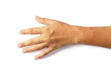 Woman's arm with red blisters on the skin due to allergic rash isolated on white background included clipping path.