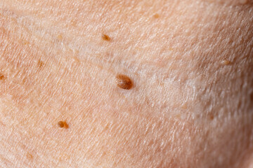 Oncology mole big wart on skin old woman. Concept dermatology body diseases malignant tumor