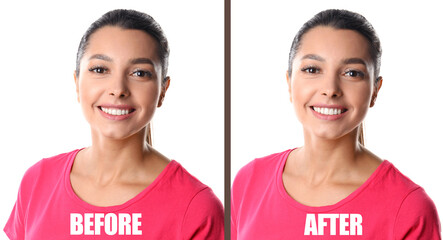 Woman before and after gingivoplasty procedure on white background. Banner design