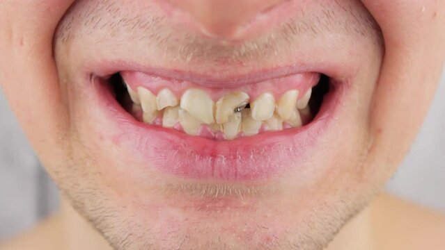 Broken teeth of a man close-up. Broken tooth enamel.