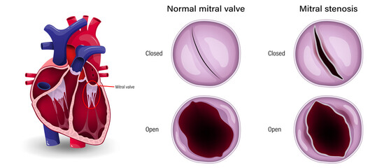 Valular heart disease. The difference of mitral stenosis and normal mitral valve. - obrazy, fototapety, plakaty