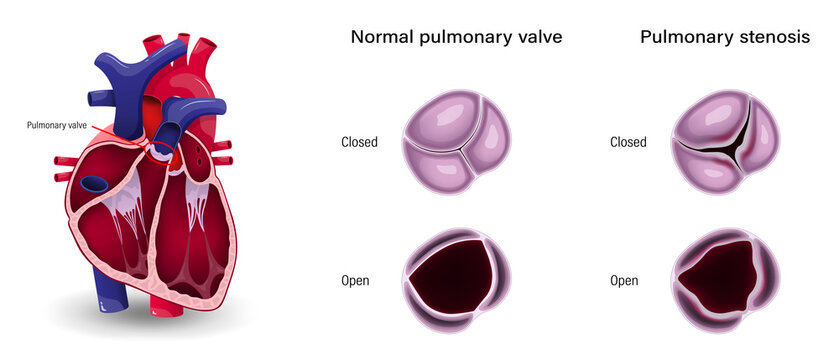 Valular heart disease. The difference of pulmonary stenosis and normal pulmonary valve.