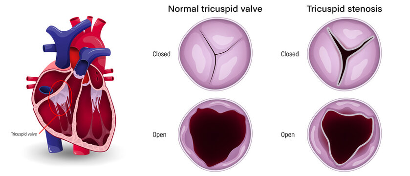 Valular heart disease. The difference of tricuspid stenosis and normal tricuspid valve.
