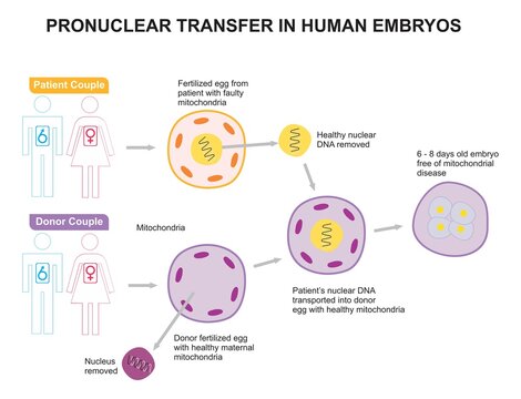 Pronuclear transfer in human embryo infographic diagram patient and donor couple mitochondria fertilized egg healthy DNA nucleus removed free of disease vector for medical science education