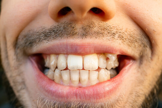 Close up of young man's face with crooked teeth. Teeth before install braces. Teeth need ortodonti.