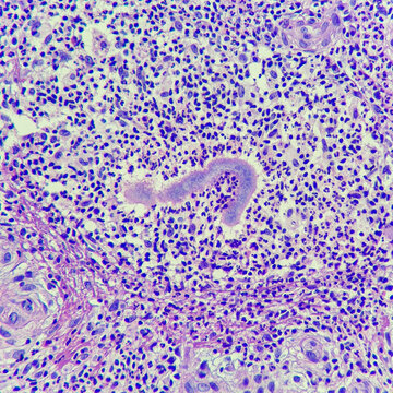 Camera photo of actinomycosis with abscess, magnification 400x, photograph through a microscope