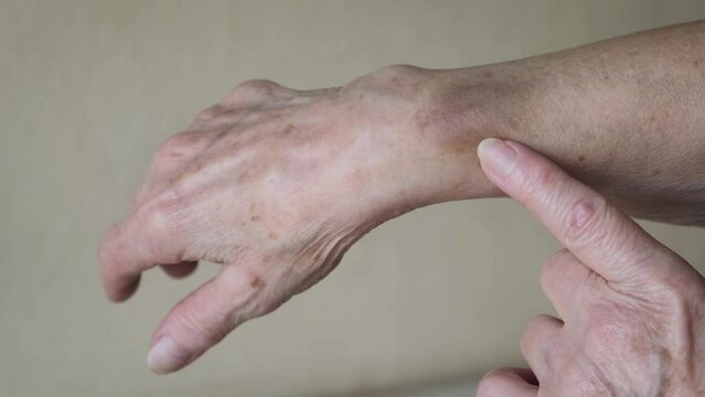 Bruise On The Skin Of An Elderly Woman, Close-up