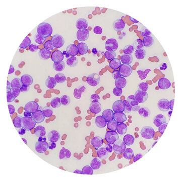 Microscopic images are acquired from blood smears of patients with Myeloid leukemia. Microscopic examination of the leukemic cells, an erythrophage in cat. Feline leukemia virus.