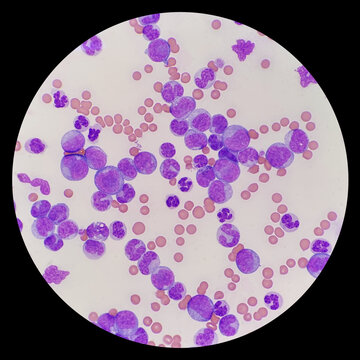 Microscopic images are acquired from blood smears of patients with Myeloid leukemia. Microscopic examination of the leukemic cells, an erythrophage in cat. Feline leukemia virus.
