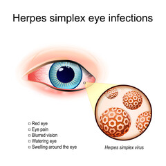 Herpes simplex eye infections. A red human's eye - obrazy, fototapety, plakaty