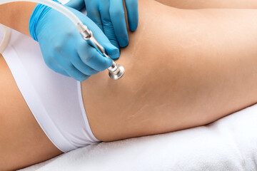 A beautician makes a microdermabrasion procedure to remove stretch marks on the thighs of a young...
