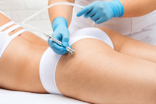 A beautician makes a microdermabrasion procedure to remove stretch marks on the thighs of a young woman.