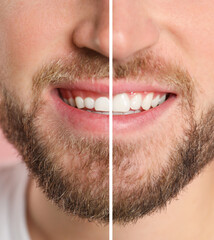 Young man before and after gingivoplasty procedure, closeup