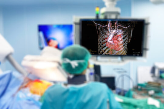 Blurry Close Up heart surgeon doctor operation heart surgery showing on monitor intervention close-up replace valve open cord surgery minimally invasive surgery, Medical health concept.