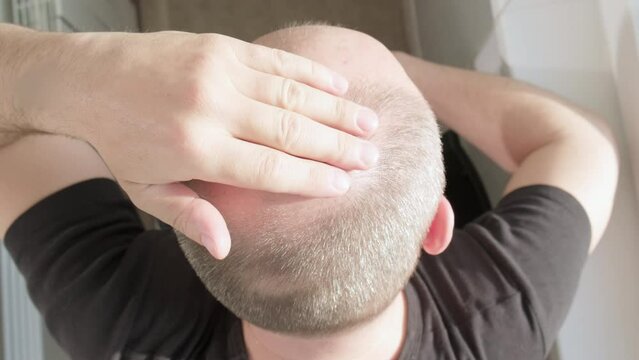 Baldness, man concerned about hair loss. Male head with a bald. Male pattern baldness. Fighting hair loss in men