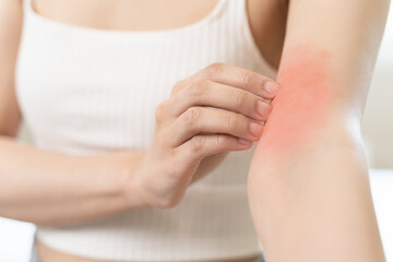 Sensitive skin allergic concept, Woman itching on her arm have a red rash from allergy symptom and...