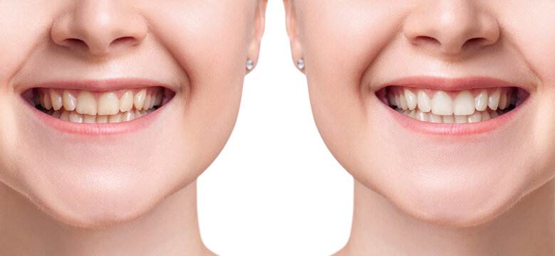 Young woman before and after whitening teeth.