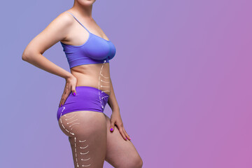Leg, buttocks, abdomen liposuction, fat and cellulite removal concept, overweight female body with painted surgical lines and arrows - obrazy, fototapety, plakaty