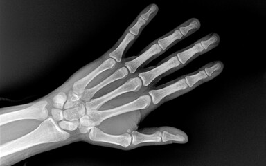 Xray of human Hand fingers top view. X-ray of male hand and wrist. X-ray of healthy whole bones of the hand close-up.