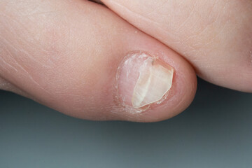 close up of a broken nail