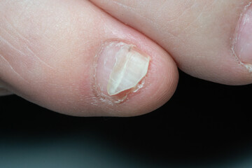 Closeup of broken nail
