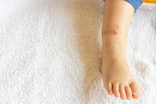 赤ちゃんの足の怪我(1歳9ヶ月、女の子、日本人)