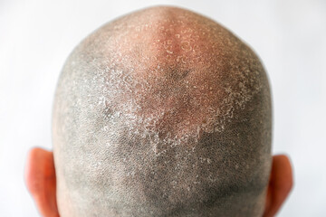 Males bald flaky head with dandruff close-up, back view. White background. The concept of psoriasis and dandruff - obrazy, fototapety, plakaty