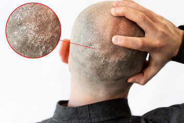 A man in a black shirt is holding his bald flaky head covered with seborrheic dermatitis and dandruff. White background with zoomed circle of skin problem. The concept of alopecia