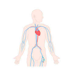 Femoral vein central venous access site shown on male body. Man with femoral central line catheter for hemodialysis, medication and fluids infusion. Medical vector illustration. - obrazy, fototapety, plakaty