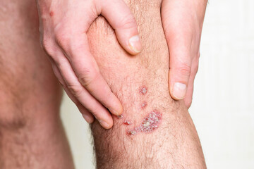 A large spot of psoriasis on the knee