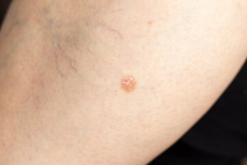 Ringworm skin infection. Dermatophytosis, mycosis on the human leg. A close-up of tinea corporis...