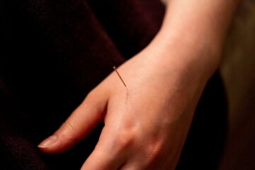 A thin acupuncture needle placed between index finger and thumb, put in place by an acupuncturist. This alternative medicine treatment is used for healing, relaxing, stimulation and stress relief.