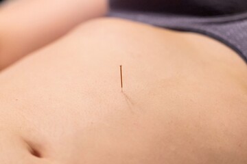 A portrait of a thin acupuncture needle between navel and sternum, put in place by an acupuncturist. This alternative medicine treatment is used for stimulation, relaxing, healing and stress relief.