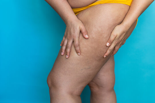 Cropped photo of fat plump overweight woman standing in yellow swimming trunks, showing cellulite of skin on leg, orange peel on blue background. Cellulite, obesity, deposition of subcutaneous fat.