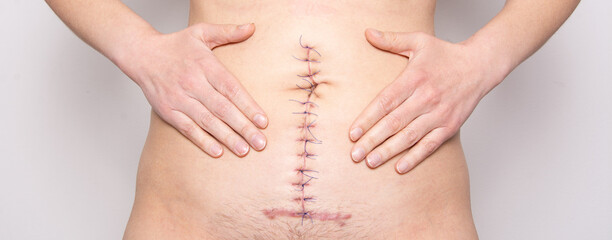Surgical stitches. Surgical wound on body. Ileus abdomen surgery