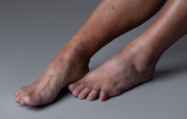 Strong allergic rashes on the leg on gray background , Dermatological rash on the skin and body The problem of health and cosmetology. Immune System Disease, Allergy