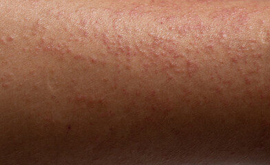 Strong allergic rashes on the leg , Dermatological rash on the skin and body The problem of health and cosmetology. Immune System Disease, Allergy