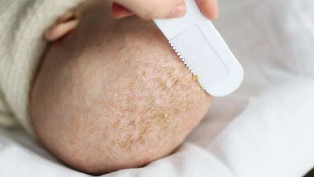 removing seborrheic dandruff flakes crusts off newborn baby child head with white comb. close-up view of infant's kid seborrhea dermatitis in hair. medical skin problem, combing and exfoliation
