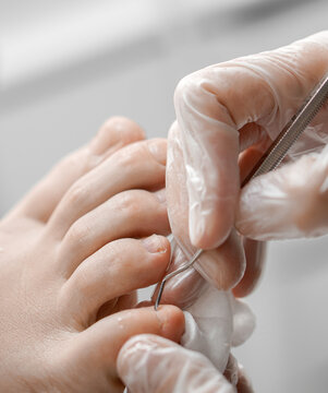 medical pedicure of problem feet of a person