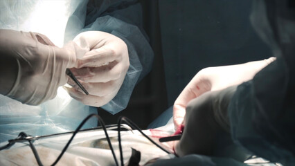 Surgeons performing operation under anesthesia. Action. Close-up surgeons open human tumor under...