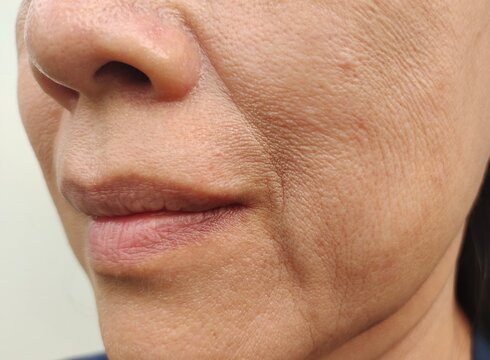 close up portrait flabbiness adipose beside the mouth, problem wrinkles and sagging skin on the face of the woman, concept health care.