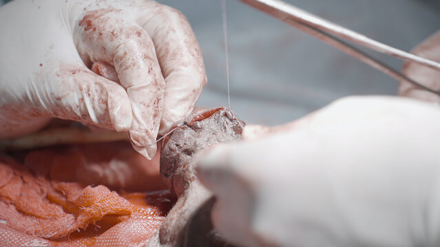 Operation on male organ. Action. Specialized surgical operation on male sexual organ. Operation of penis fracture or its enlargement. Close-up of surgeons performing surgery on male sexual organ