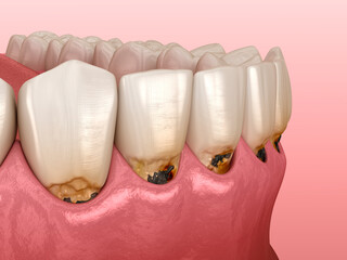 Cervical caries on frontal teeth. Dental 3D illustration - 502382301