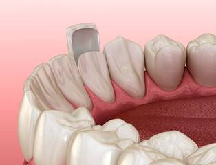 Dental veneer placement procedure. Dental 3D illustration