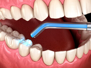 Tooth restoration with filling and polymerization lamp. Dental 3D illustration